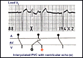 ecg_0277_mod.gif